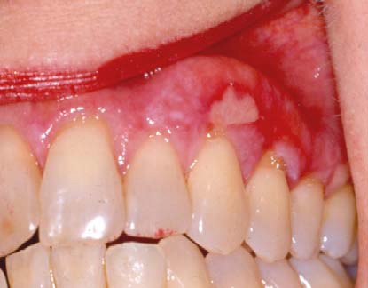 Oral Lichen Planus Gums Oral Lichen Planus Causes Symptoms And
